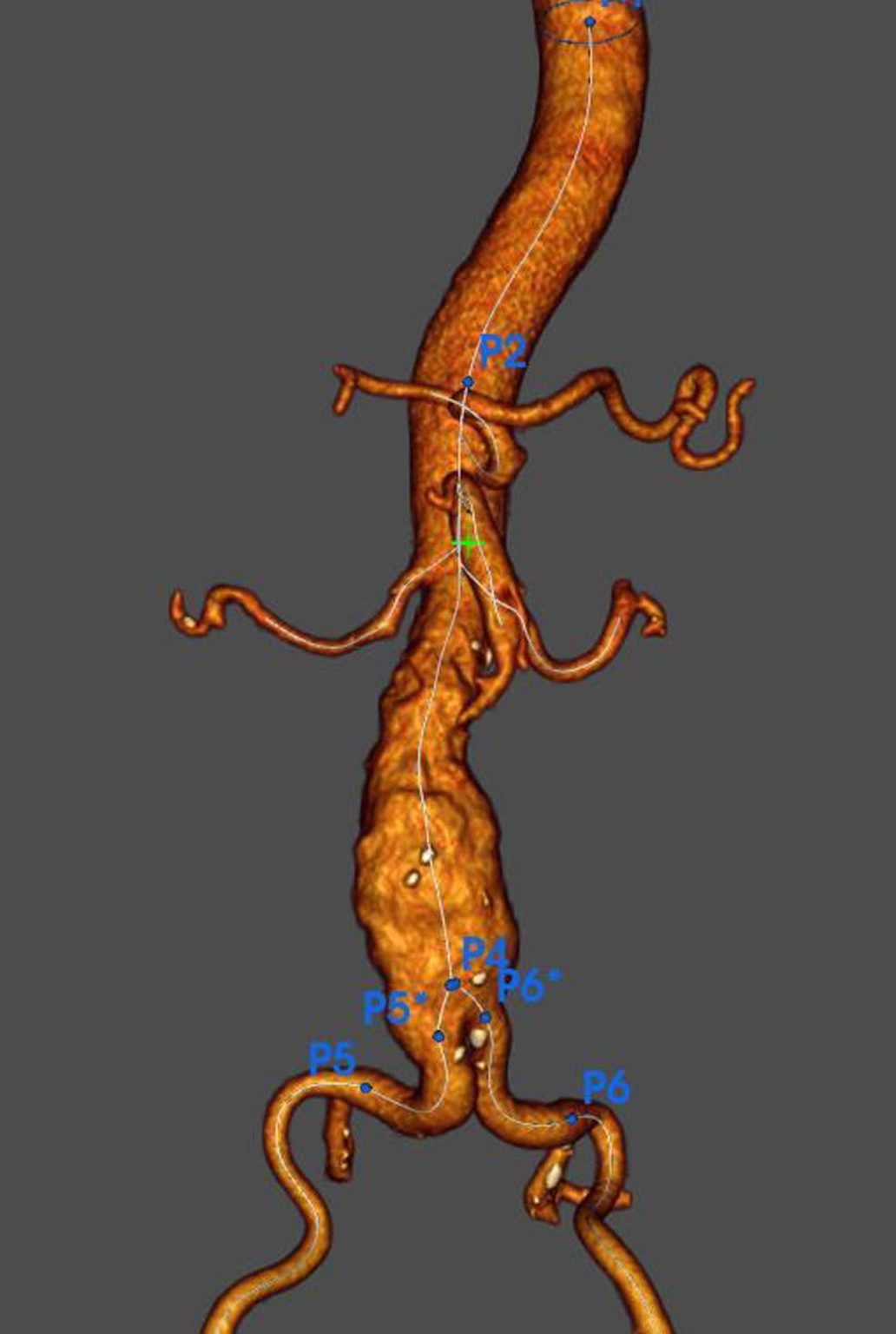 Caso clínico: aneurisma de aorta abdominal - Cirugía Cardiovascular ...
